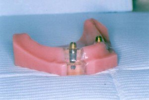 Doylestown Dentist Implant
