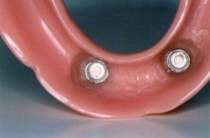 Doylestown Dentist Implant 2