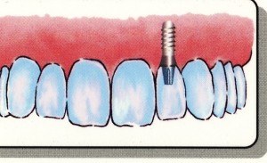 Doylestown Dentist Implant 3